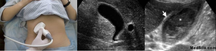 УЗИ желчного пузыря, норма и утолщение стенок, характерное для воспаления желчного пузыря.